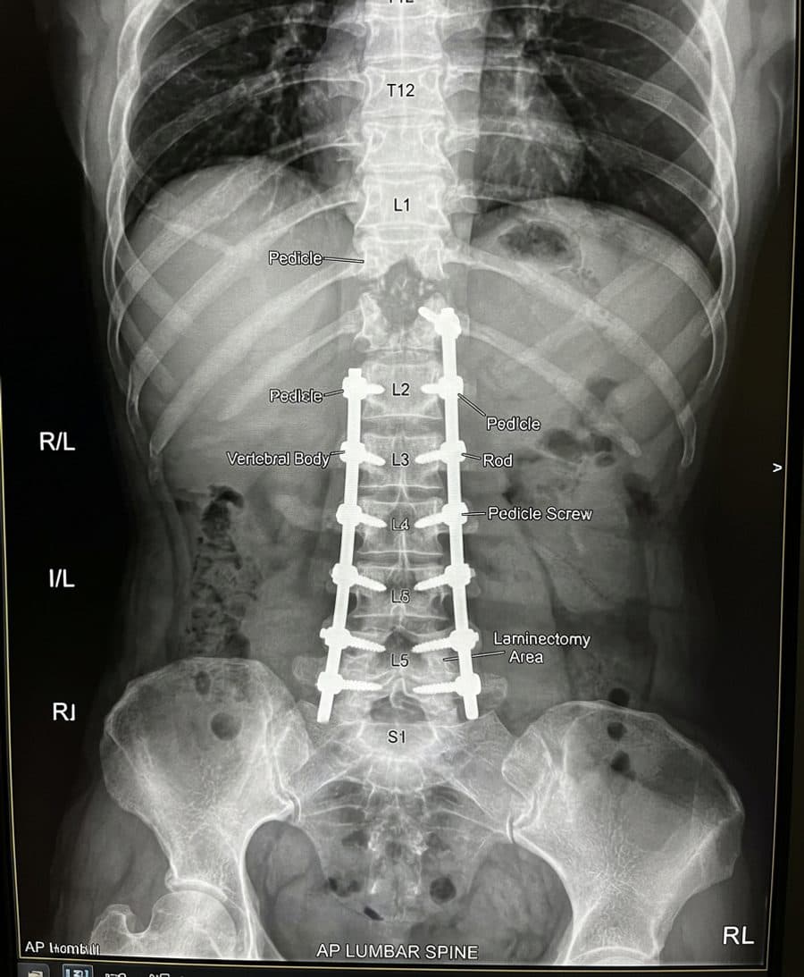 Post-operative lumbar fusion X-ray showing pedicle screws and rods